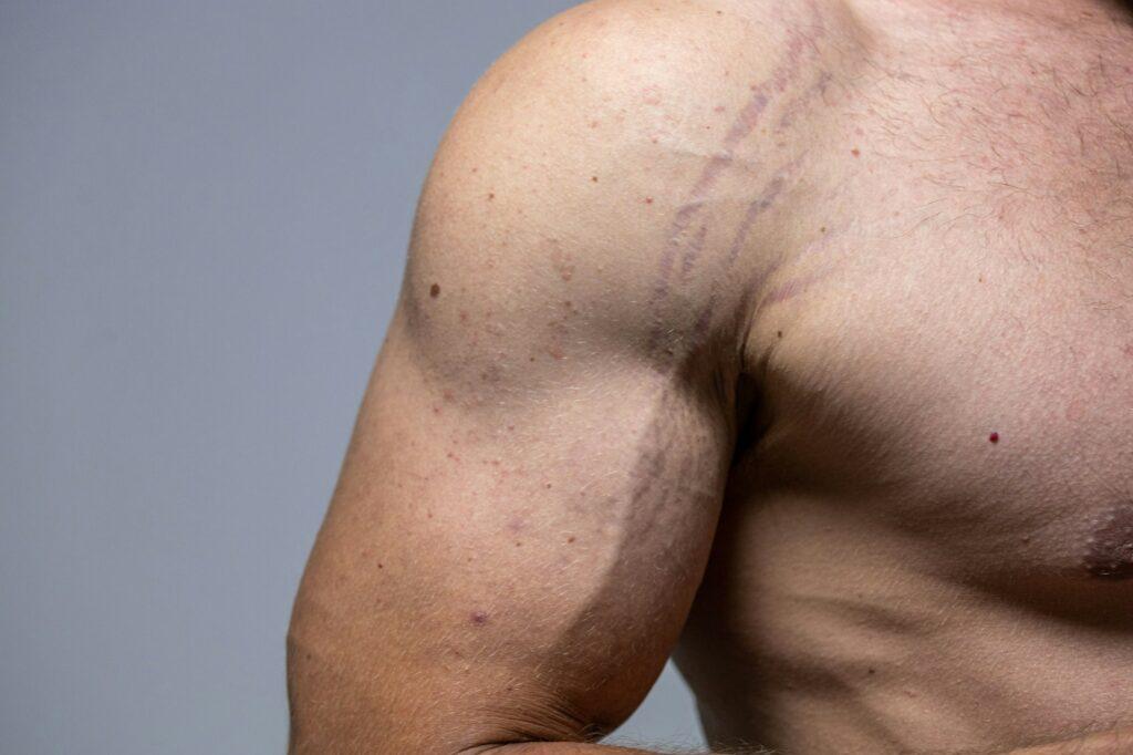 stretch marks on the arm