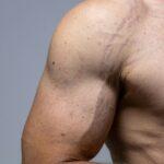 stretch marks on the arm